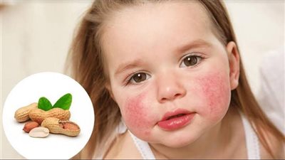 ماذا تعرف عن حساسية الفول السوداني؟.. أسبابها وأعراضها وكيفية التعامل معها