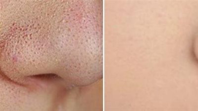 التحكم في المسامات الواسعة..ماسكات طبيعية لبشرة أفضل