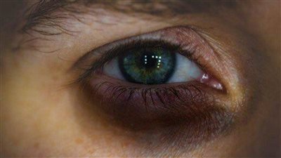 العناية الطبيعية بالبشرة.. استخدام الطماطم والليمون للتخلص من الهالات السوداء تحت العينين