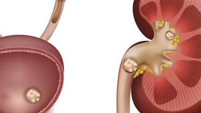 علاج حصى الكلى.. استراتيجيات شاملة للتخلص من الحصى وتخفيف الأعراض