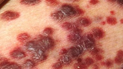 تعرف على مرض الايدز