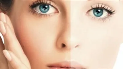 علاج اسمرار الشمس.. أشهر الوصفات الطبية والطبيعية 