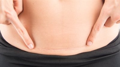 بعد الولادة القيصرية.. التعافي والنصائح المهمة