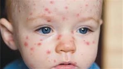 كل ما تريد معرفته عن مرض الجدرى