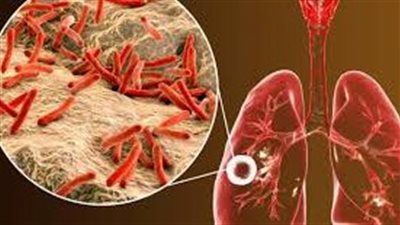 كل ما تريد معرفته عن مرض الدرن
