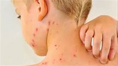 مرض الحصبة.. الأسباب والاعراض والعلاج