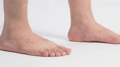 عناية فعّالة وعلاج لمسمار القدم..دليل شامل