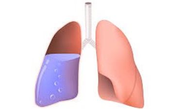 ماء الرئة.. أعراضه وأسبابه وطرق علاجه