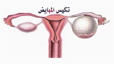 تعرف على مدة علاج تكيس المبايض بين الفحص الطبي والعناية الشخصية 