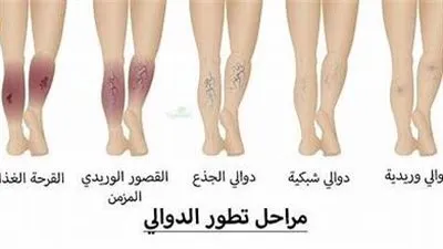 طرق علاج إزالة الدوالي