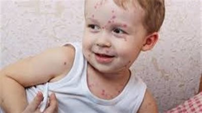 ما هو العنقز وهل يصيب الأطفال فقط؟..(أعراضه وطرق الوقاية والعلاج)