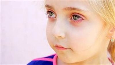 أعراض وطرق علاج العيون الحمراء عند الأطفال