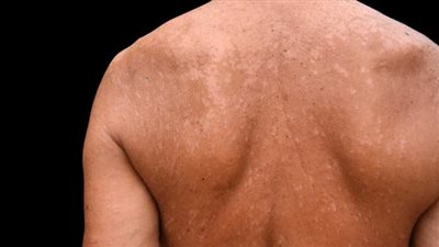  الأمراض الجلدية - تشخيص وعلاج للحفاظ على صحة البشرة 