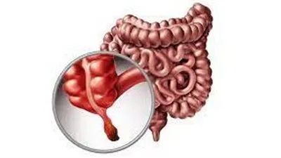 تعرف علي إصابات الزائدة الدودية وعلاجها