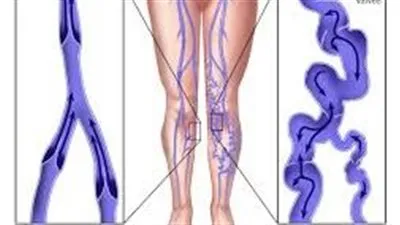 دوالي الساقين..الأسباب والأعراض والعلاج ( تفاصيل )