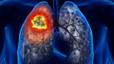 سرطان الرئة| الأعراض ووسائل الوقاية 