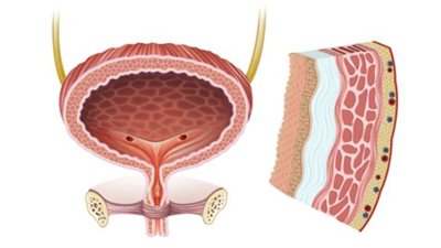 تعرف على سلس البول|أسبابه وكيفية التعامل معه 