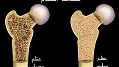 هشاشة العظام.. كيف تحمي عظامك من الكسر؟