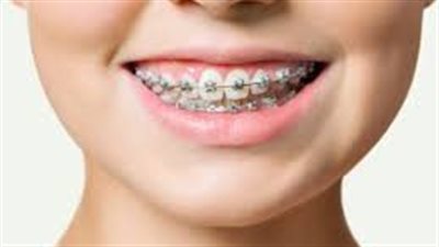 تقويم الأسنان..أنواعه وفوائده وكيفية اختياره ( تفاصيل )