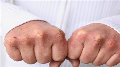 نصائح وإرشادات للتخفيف من تشقق اليدين