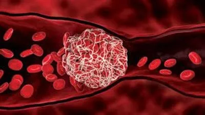 فحص تخثر الدم..ما هو؟ ومتى يتم إجراؤه؟