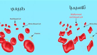 ( الثلاسيميا) أعراضها وعلاجها وطرق الوقاية منها