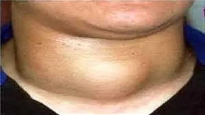 تعرف على أسباب نقض اليود