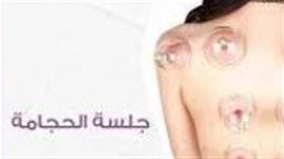 لو هتعملي حجامة.. شروط لكي سيدتي قبل البدء في الحجامة