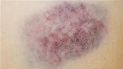 أسباب ظهور الكدمات على الجسم وكيفية التعامل معها بشكل فعّال