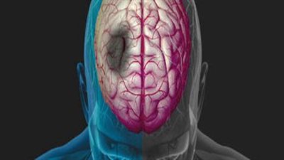 جلطة الأوعية الدموية: أنواعها وأعراضها المبكرة التي لا يمكن تجاهلها