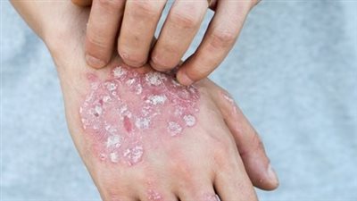  مرض الصدفية: التحديات والعلاج 