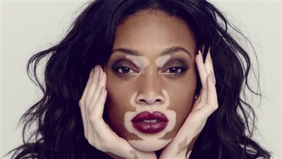 مرض البهاق: تحديات الجلد والتأثير النفسي 