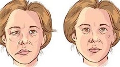 شلل العصب الوجهي..تعرف على الأسباب والاعراض واشهر طرق العلاج 