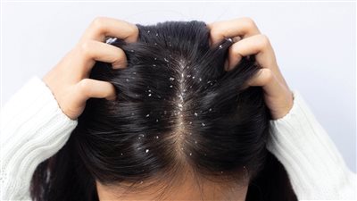 الحل للتخلص من قشرة الشعر نهائيا..وصفات منزلية للقضاء عليها فى أسبوع واحد