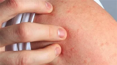 الهيستامين: الكيمياء والوظائف وتأثيره في حالات الحساسية