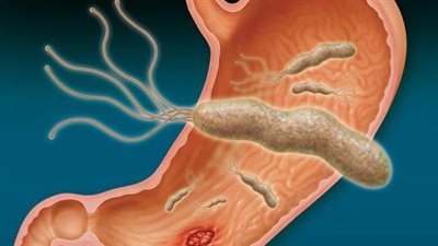 أسباب الإصابة وطرق انتشار جرثومة المعدة.. تعرف عليها