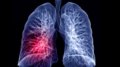 الالتهاب الرئوي: أسبابه وأعراضه ومشروبات تساعد على التخلص منه 