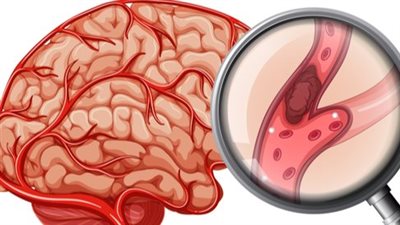  جلطات المخ: خطورتها الأسباب وكيفية الوقاية 