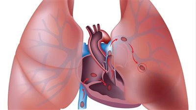  جلطات الشريان الرئوي: خطورة وأسباب وسبل الوقاية 