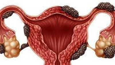 أعراض وأسباب بطانة الرحم المهاجرة ومضاعفتها