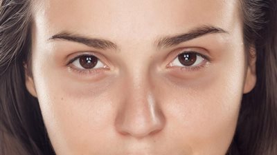 كيفية علاج الهالات السوداء