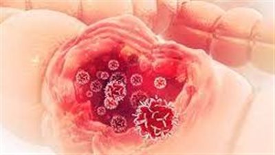 الأسباب المجهولة لسرطان القولون: فك شفرة التحليل والتوعية