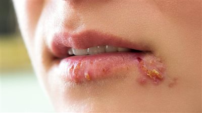 علاج الحبوب حول الفم.. استراتيجيات فعّالة للعناية بالبشرة