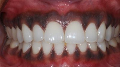 سواد اللثة.. أسبابه وخطوات فعّالة لتحسين صحة اللثة وجمال الابتسامة