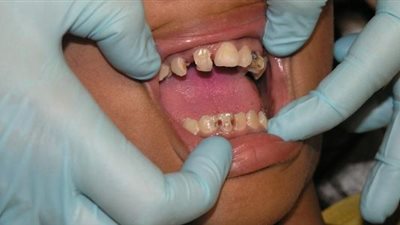 المشاكل الصحية المسببة للتسوس.. تعرفي عليها