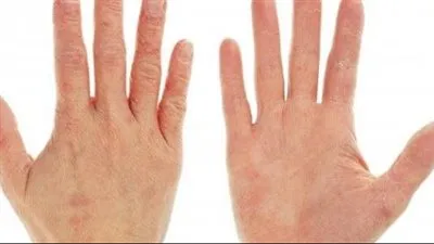 تحديات جفاف اليدين.. أسبابها وحلول فعّالة للعناية بالبشرة