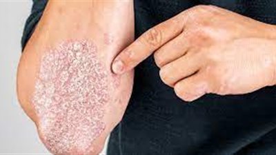 الصدفية: فهم متعمق للمرض وتأثيره على الحياة اليومية 