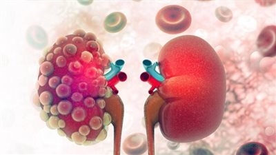 الفشل الكلوي: أسبابه وسبل الوقاية والعلاج 