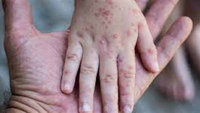 أستاذ صحة عامة توضح أعراض الجديري المائي وحقيقة انتشاره بين طلاب المدارس (فيديو)