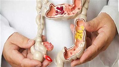 دون أدوية.. تعرف على طريقة سهلة لعلاج القولون نهائيًا (فيديو)